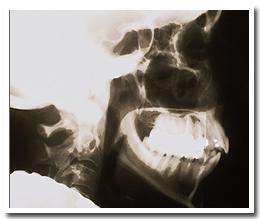 X-Ray of skull showing teeth and jaw