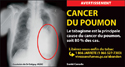 Radiographie thoracique dmontrant un poumon atteint du cancer.